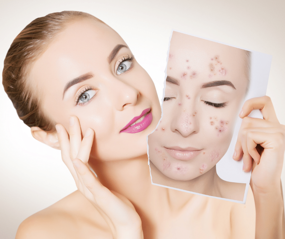 acne-the-basics-an-estheticians-review